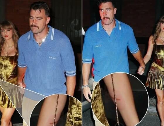 Fans Spot Taylor Swift’s Visible Scars in Photo with Travis Kelce – Fuels New Speculation!”